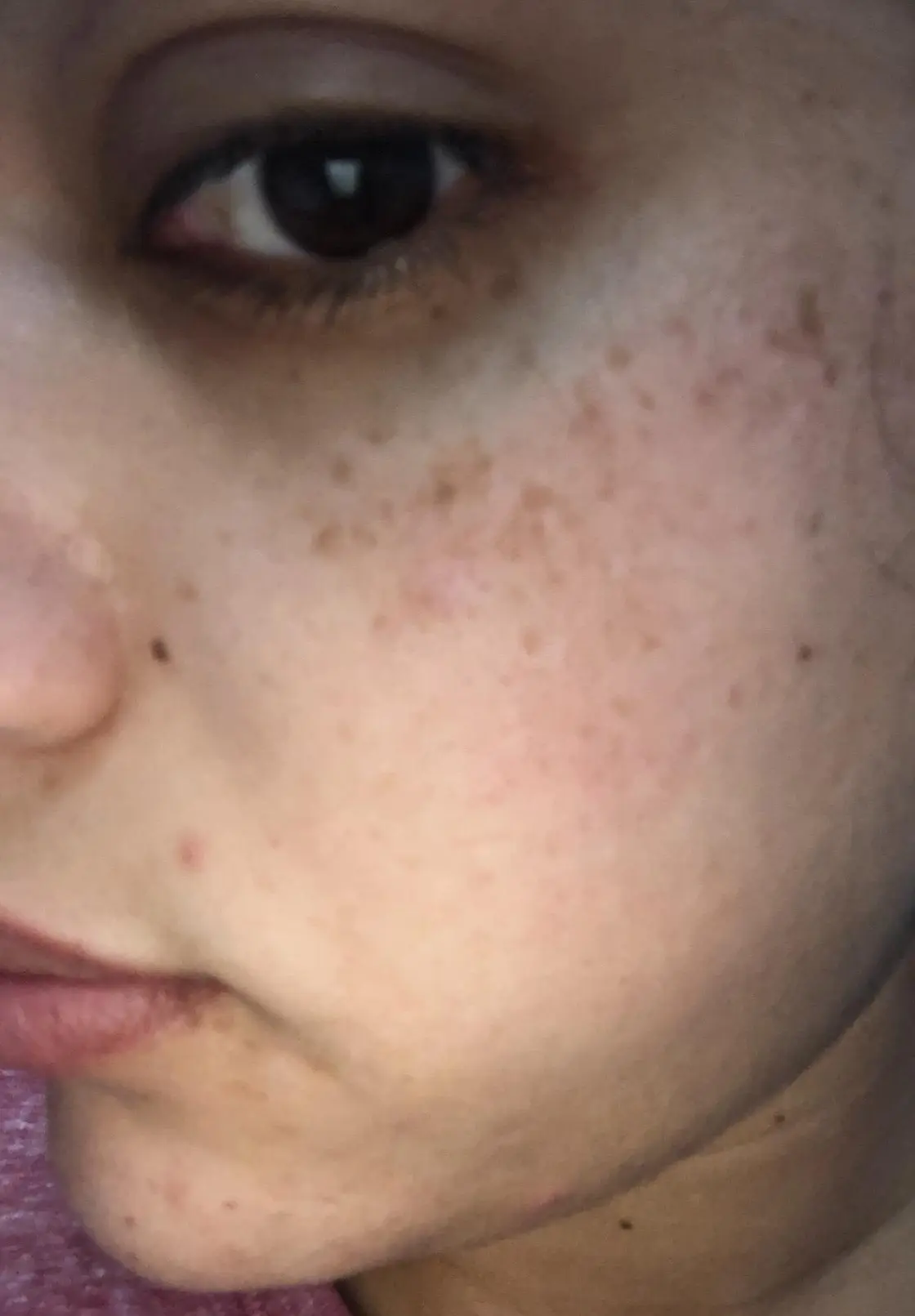 Before — Before and after using YEOUTH Glycolic Acid Gel Peel — visible improvement in skin texture