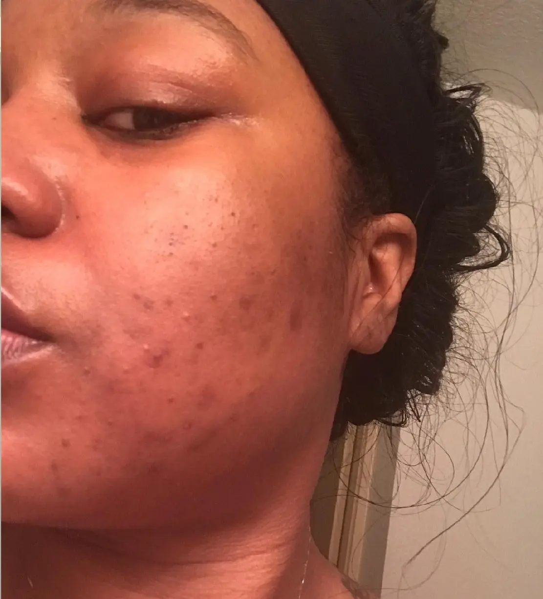 After — Before and after results — clearer, smoother skin with YEOUTH Glycolic Peel