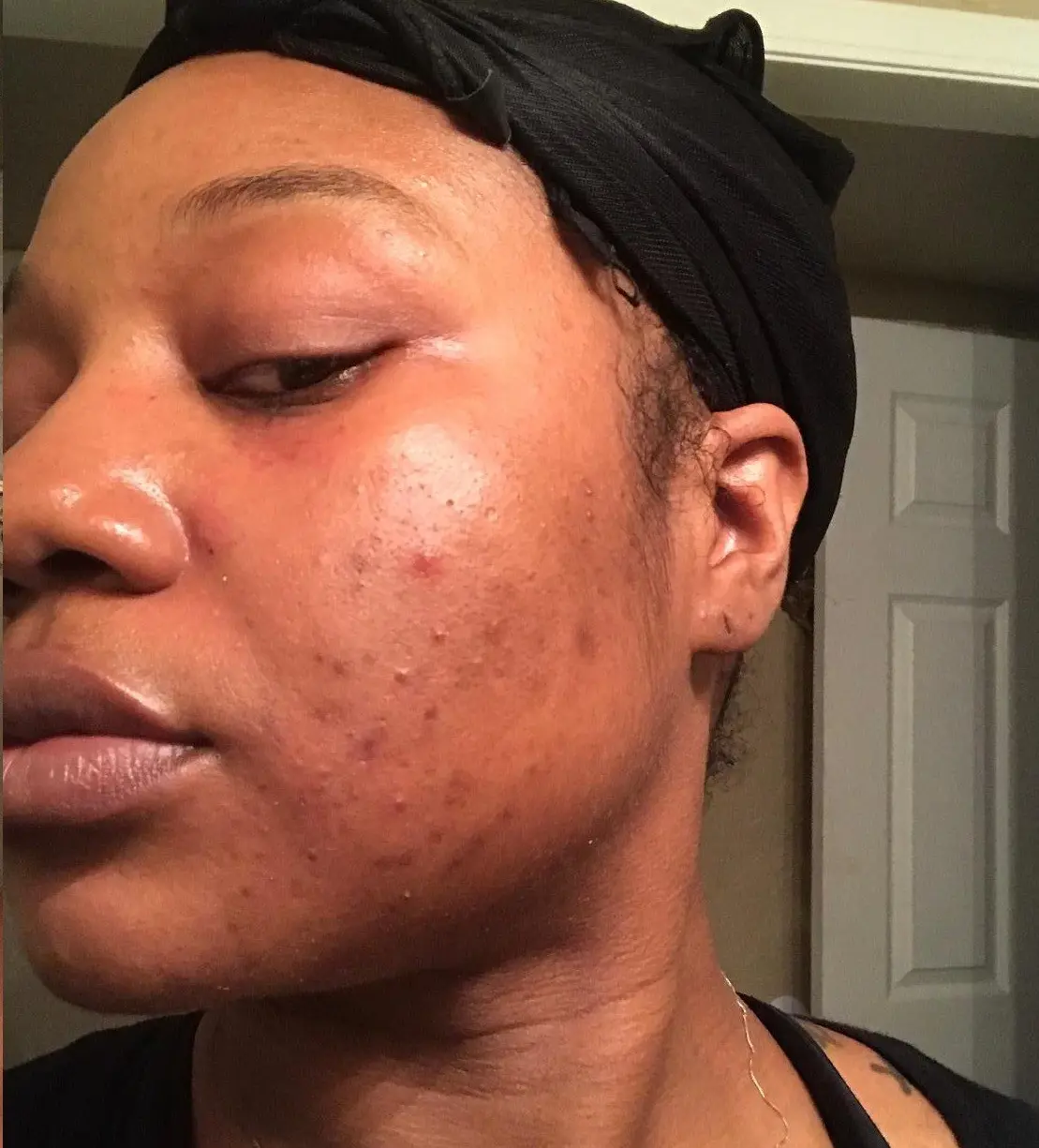 Before — Before and after results — clearer, smoother skin with YEOUTH Glycolic Peel