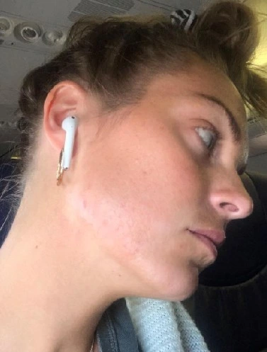 After — Skin transformation — before and after YEOUTH Glycolic Acid Peel treatment