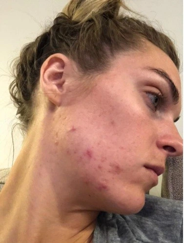 Before — Skin transformation — before and after YEOUTH Glycolic Acid Peel treatment